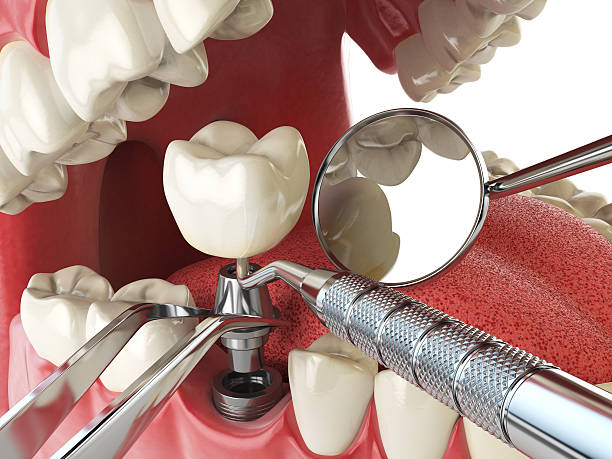 Best Broken or Cracked Tooth Emergency Dentist in Tumter, WA